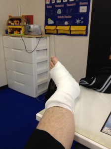 ankle cast